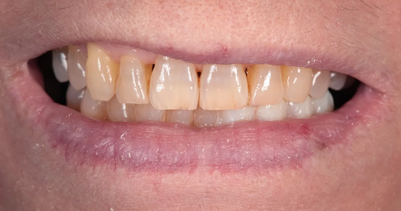 Antes - Caso 2 · Rehabilitación estética