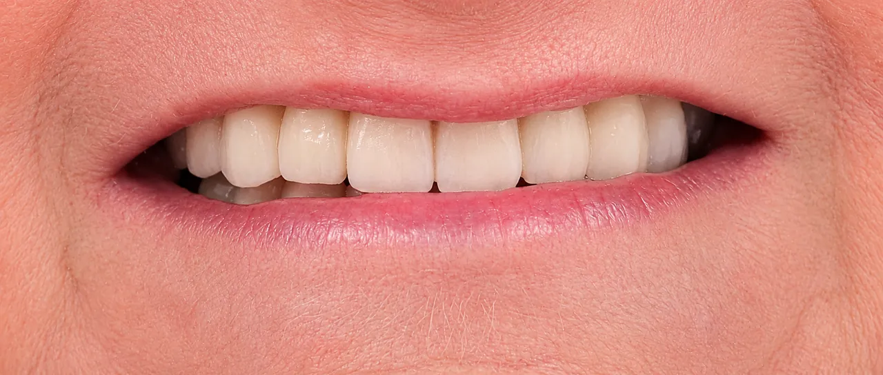 Después - Caso 3 · Blanqueamiento dental